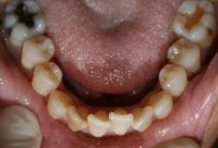 Invisalign Lower Arch Before