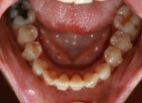 Invisalign Lower Arch After