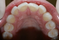 Invisalign Upper Arch Before