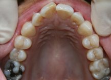 Invisalign Upper Before