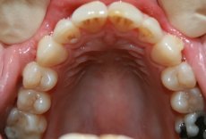 Invisalign Upper After