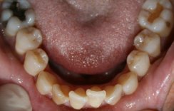 Invisalign Bottom Before