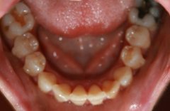 Invisalign Bottom After